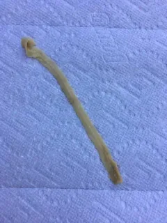 Broad Tapeworm thumbnail 3