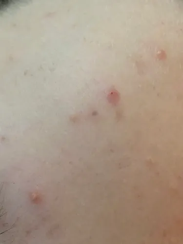 Cutibacterium acnes