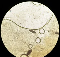 Massaria vomitoria thumbnail 1