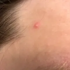 Cutibacterium acnes thumbnail 4