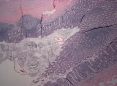 Human pinworm thumbnail 2