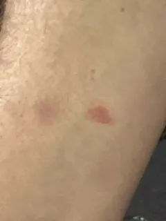 Ringworm thumbnail 2