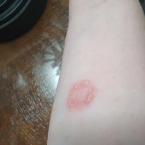 Ringworm