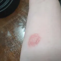Ringworm thumbnail 1