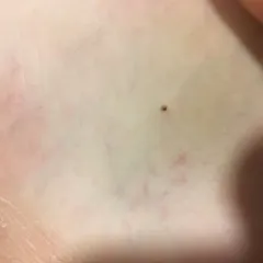 Eastern Black-legged Tick thumbnail 3