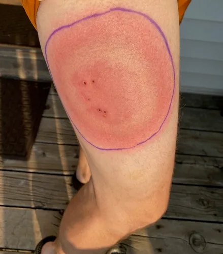 Lyme Disease Spirochete
