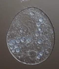 Glaucoma scintillans thumbnail 2