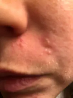 Cutibacterium acnes thumbnail 2