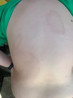 Lyme Disease Spirochete thumbnail 2