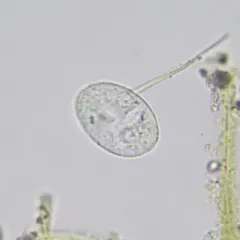 Glaucoma scintillans thumbnail 1