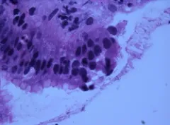 Helicobacter pylori thumbnail 2