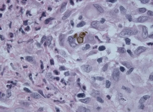 Fonsecaea pedrosoi
